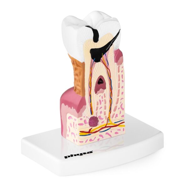 Model anatomiczny chorego zęba człowieka w skali 6:1 1 10040250 1