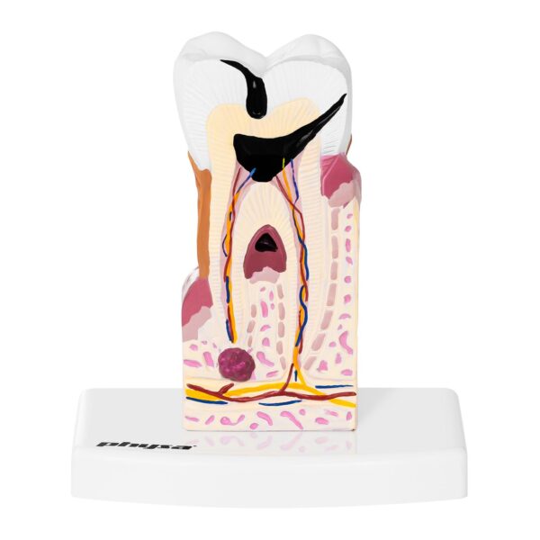 Model anatomiczny chorego zęba człowieka w skali 6:1 2 10040250 2