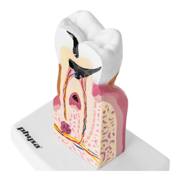 Model anatomiczny chorego zęba człowieka w skali 6:1 4 10040250 4