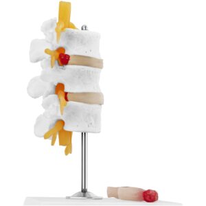 Model anatomiczny 3D odcinka lędźwiowego kręgosłupa z przepukliną kręgi 3-5 6 Model anatomiczny 3D odcinka lędźwiowego kręgosłupa z przepukliną kręgi 3-5 - obrazek 3