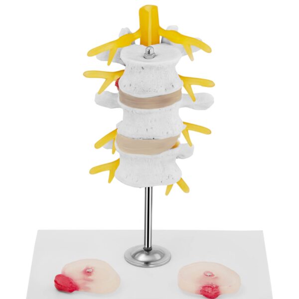 Model anatomiczny 3D odcinka lędźwiowego kręgosłupa z przepukliną kręgi 3-5 3 10040324 3