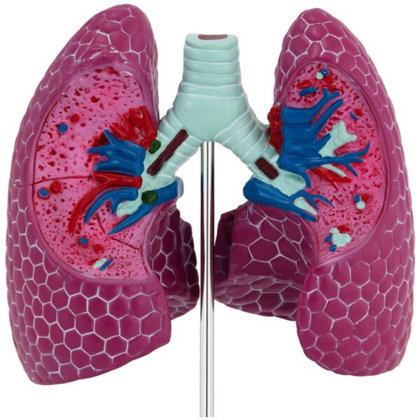 Model anatomiczny 3D płuca człowieka ze zmianami chorobowymi 2 10040329 2