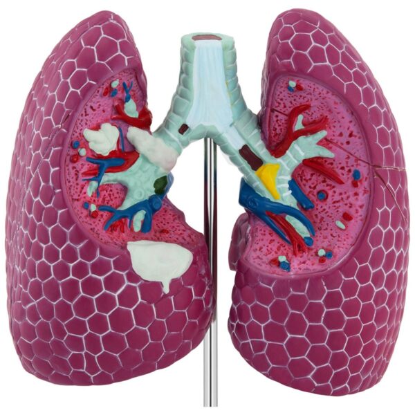 Model anatomiczny 3D płuca człowieka ze zmianami chorobowymi 3 10040329 3